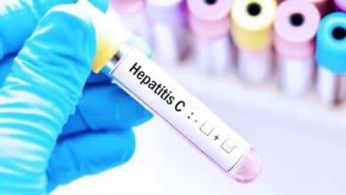 Hepatitis C.