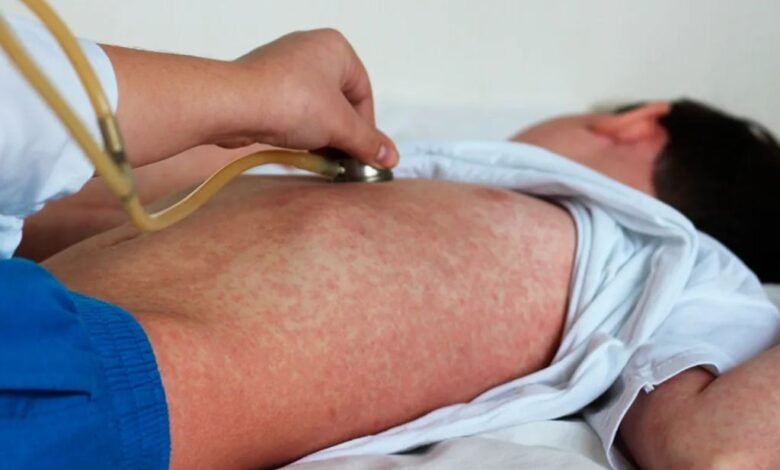 Resurgimiento del sarampión en Europa llamado urgente a la vacunación