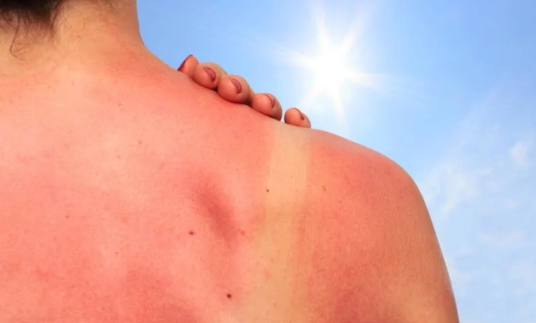 Evite cáncer de piel por exposición excesiva a rayos ultravioleta IMSS Tabasco