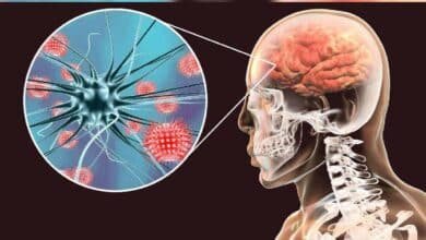 Mantiene Secretaría de Salud seguimiento en casos de Neuroinfección