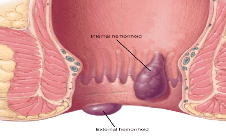 Hemorroides. Causas y tratamiento