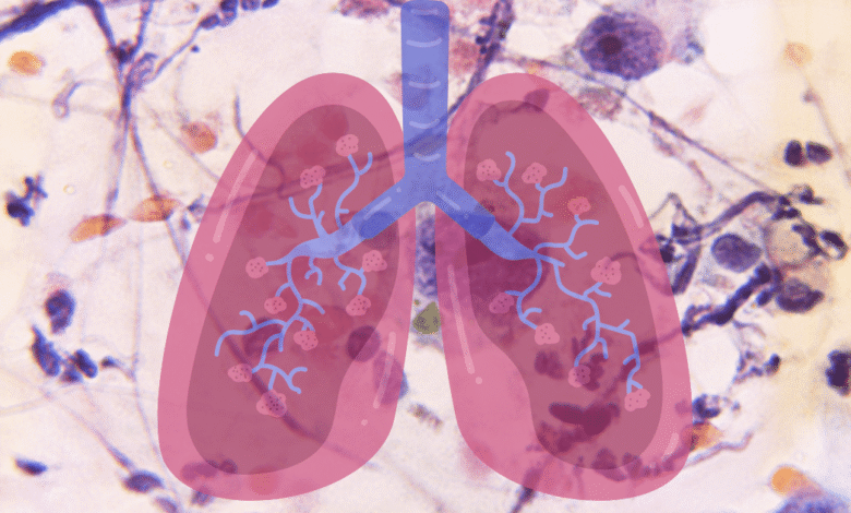 Enfermedades pulmonares las cinco afecciones más comunes en América Latina