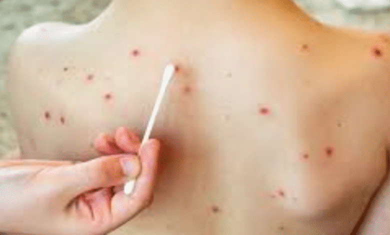 El segundo caso de Sarampión importado desata la vigilancia sanitaria