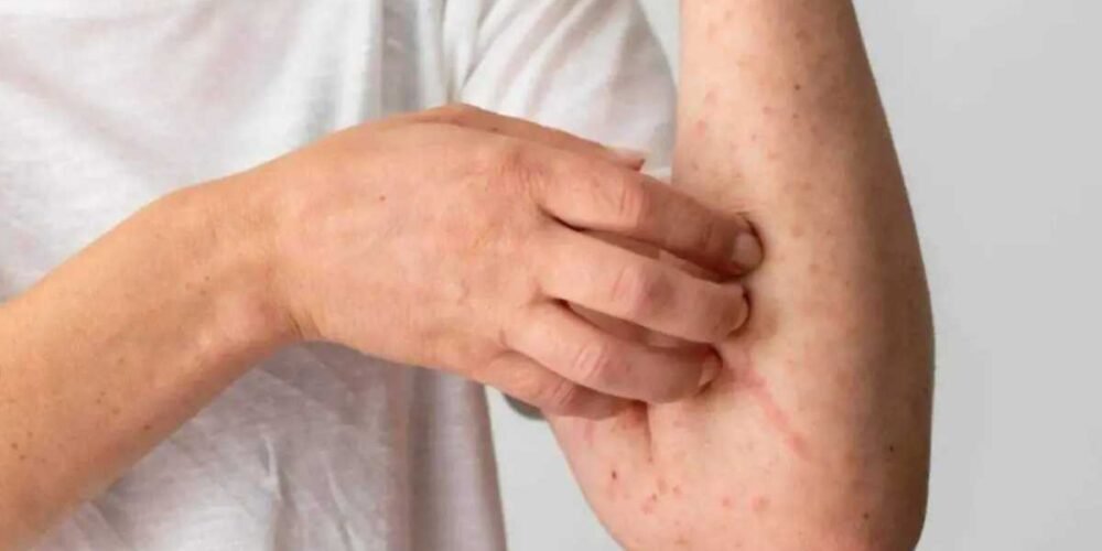 Confirman dos casos de sarampión en Tabasco, vigila 80 posibles contagios