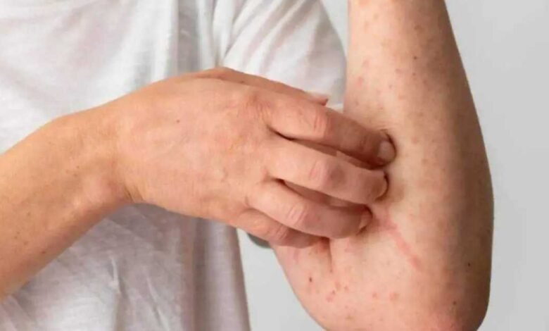 Confirman dos casos de sarampión en Tabasco, vigila 80 posibles contagios