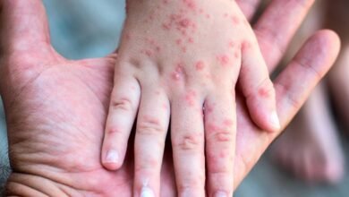 Autoridades confirman siete contagios de sarampión en Tabasco