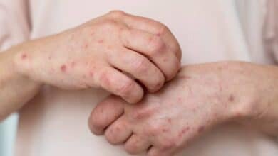 Suman siete casos de Sarampión en Tabasco