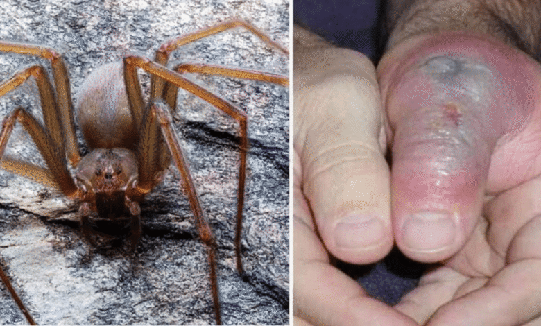 Piquete de araña violinista: ¿Cómo identificarla y qué hacer si te pica?