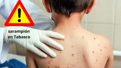Escala contagios de sarampión en primer mes del 2026