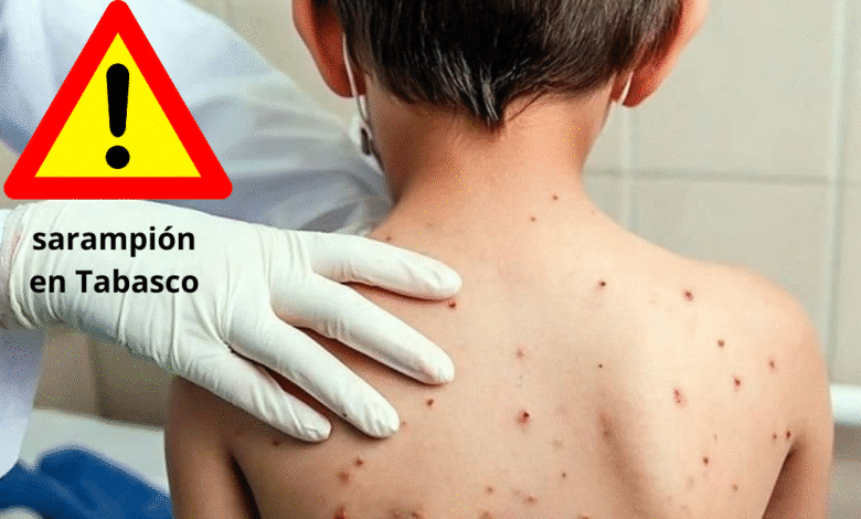Escala contagios de sarampión en primer mes del 2026