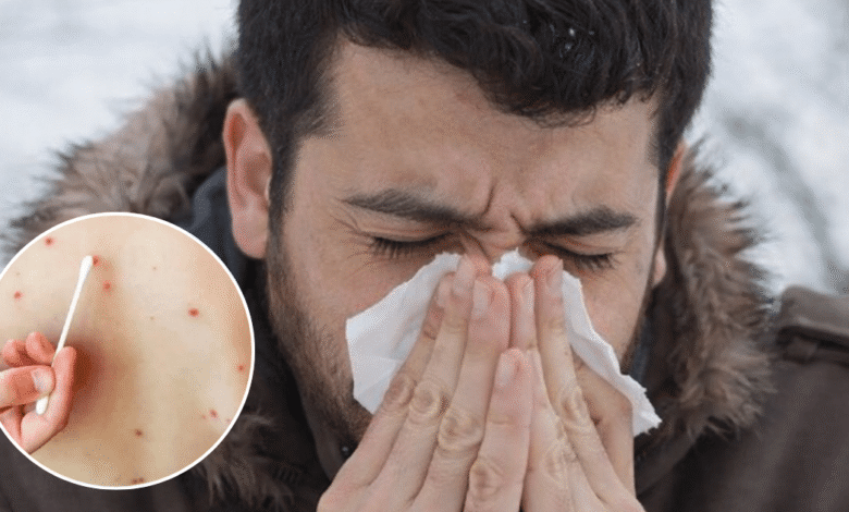 Síntomas y contagio del sarampión: ¿Cuánto tiempo tarda en manifestarse el virus?