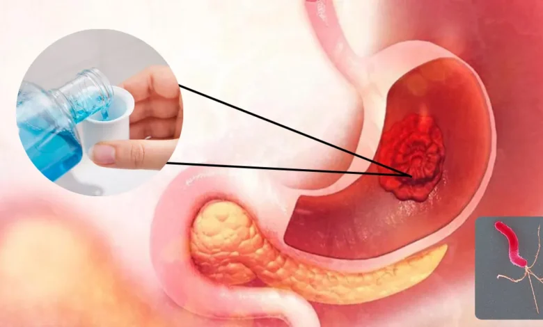 Científicos descubren cómo un simple enjuague bucal ayudaría a identificar el cáncer gástrico (Fotos internetredes)