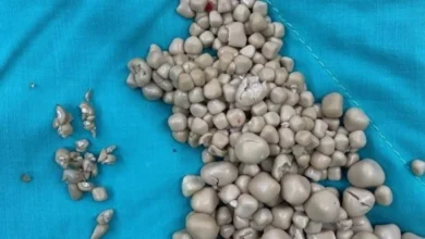 joven de 20 años llega con fiebre y médicos encuentran más de 300 piedras en un riñón