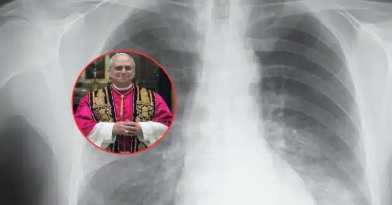 qué es el adenocarcinoma pulmonar, el tumor detectado al papa león xiv